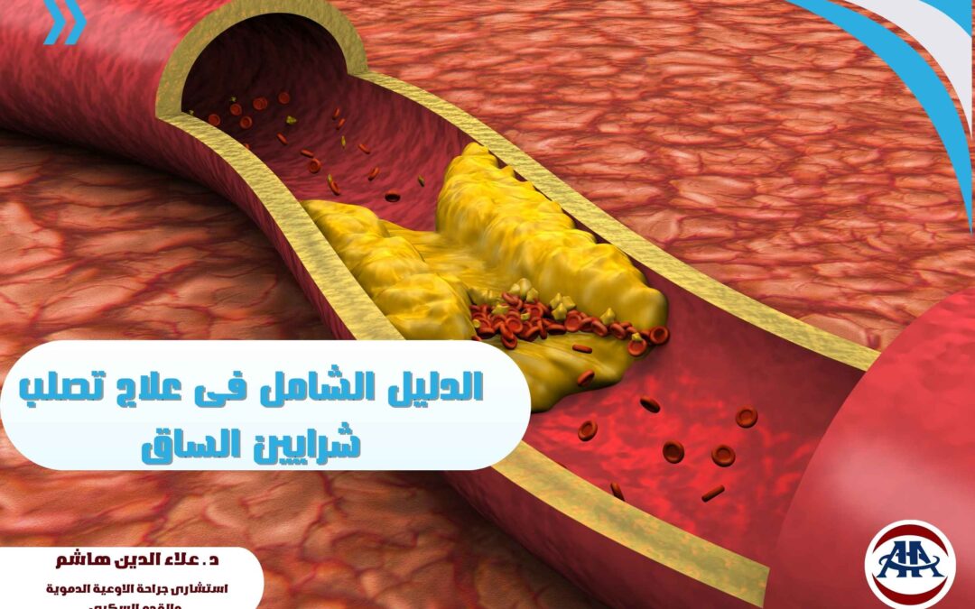 الدليل الشامل فى علاج تصلب شرايين الساق