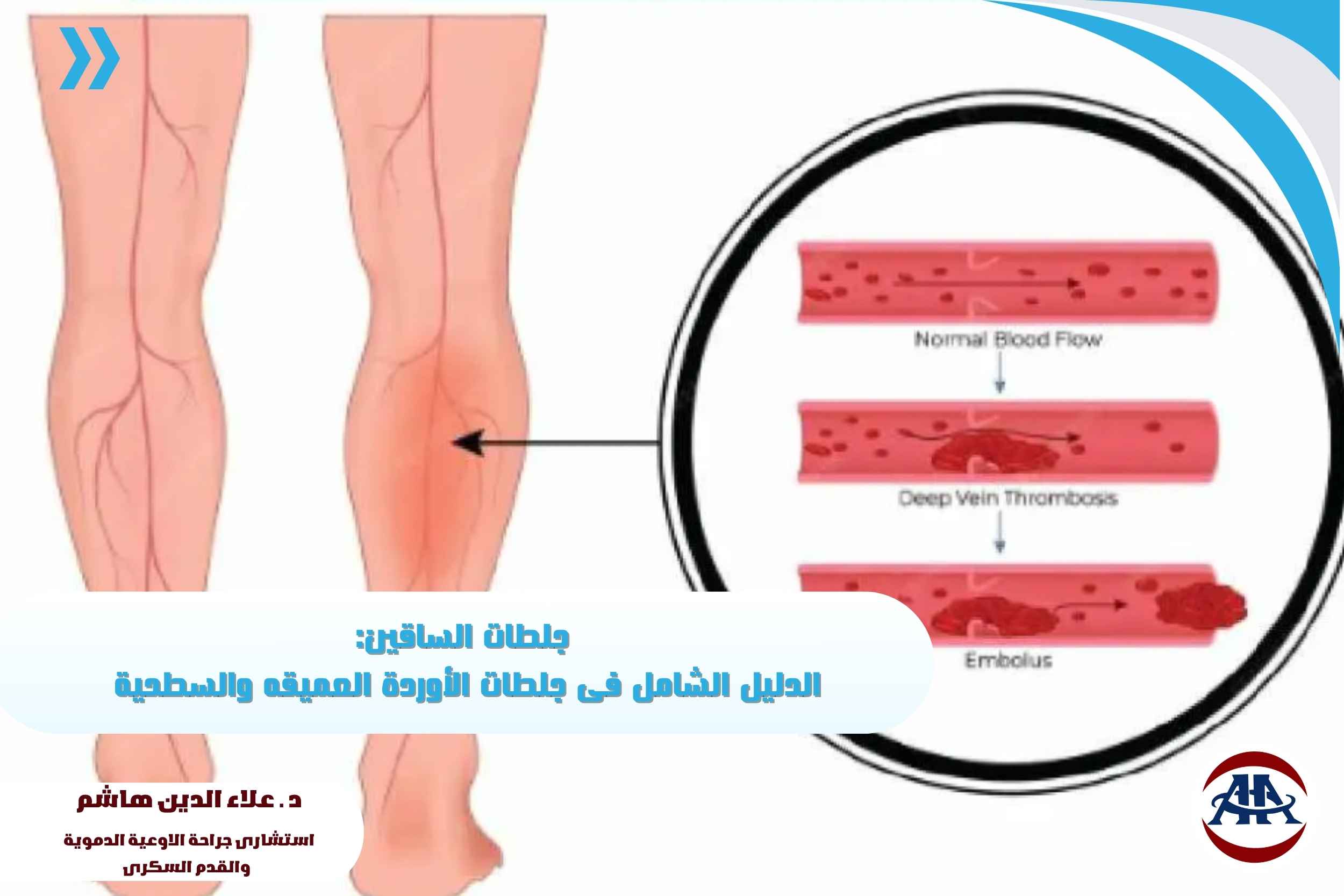جلطات-الساقين (1) جلطات-الساقين