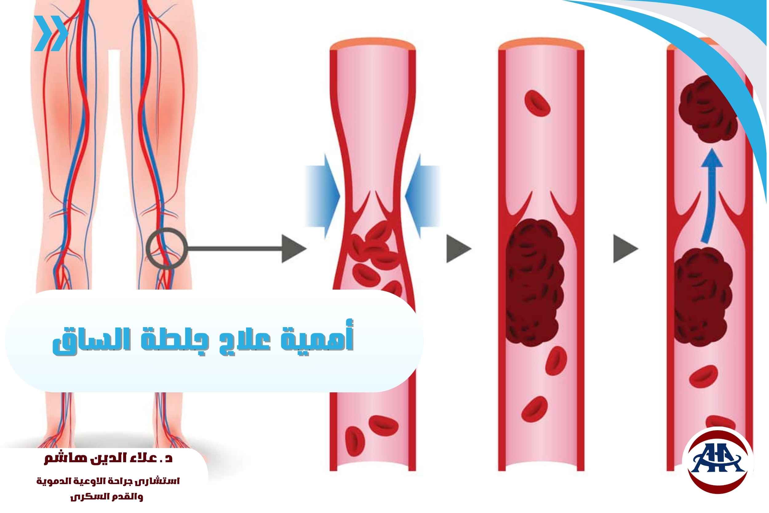 علاج-جلطة-الساق (1) علاج-جلطة-الساق