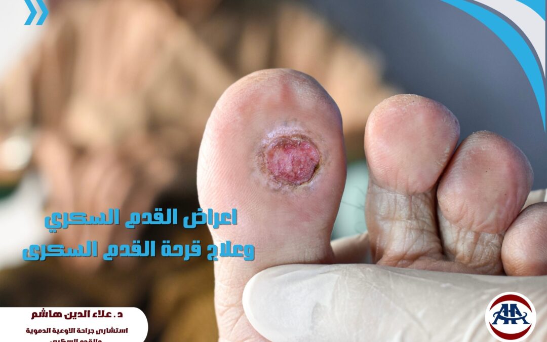 اعراض القدم السكري وعلاج قرحة القدم السكرى