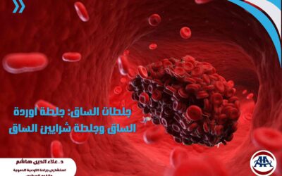 د.علاء الدين هاشم جلطات الساق: جلطة اوردة الساق وجلطة شرايين الساق