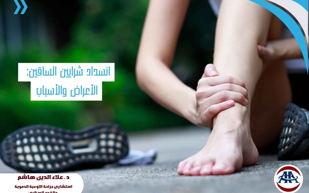انسداد شرايين الساقين: الأعراض والأسباب