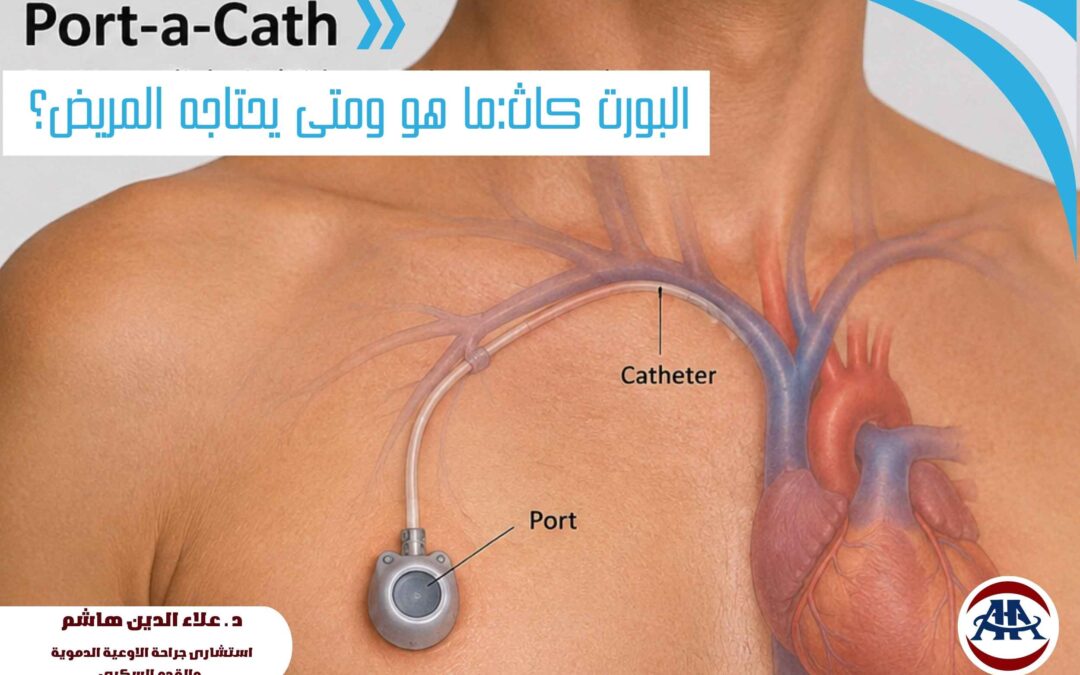 البورت كاث: ما هو ومتى يحتاجه المريض؟