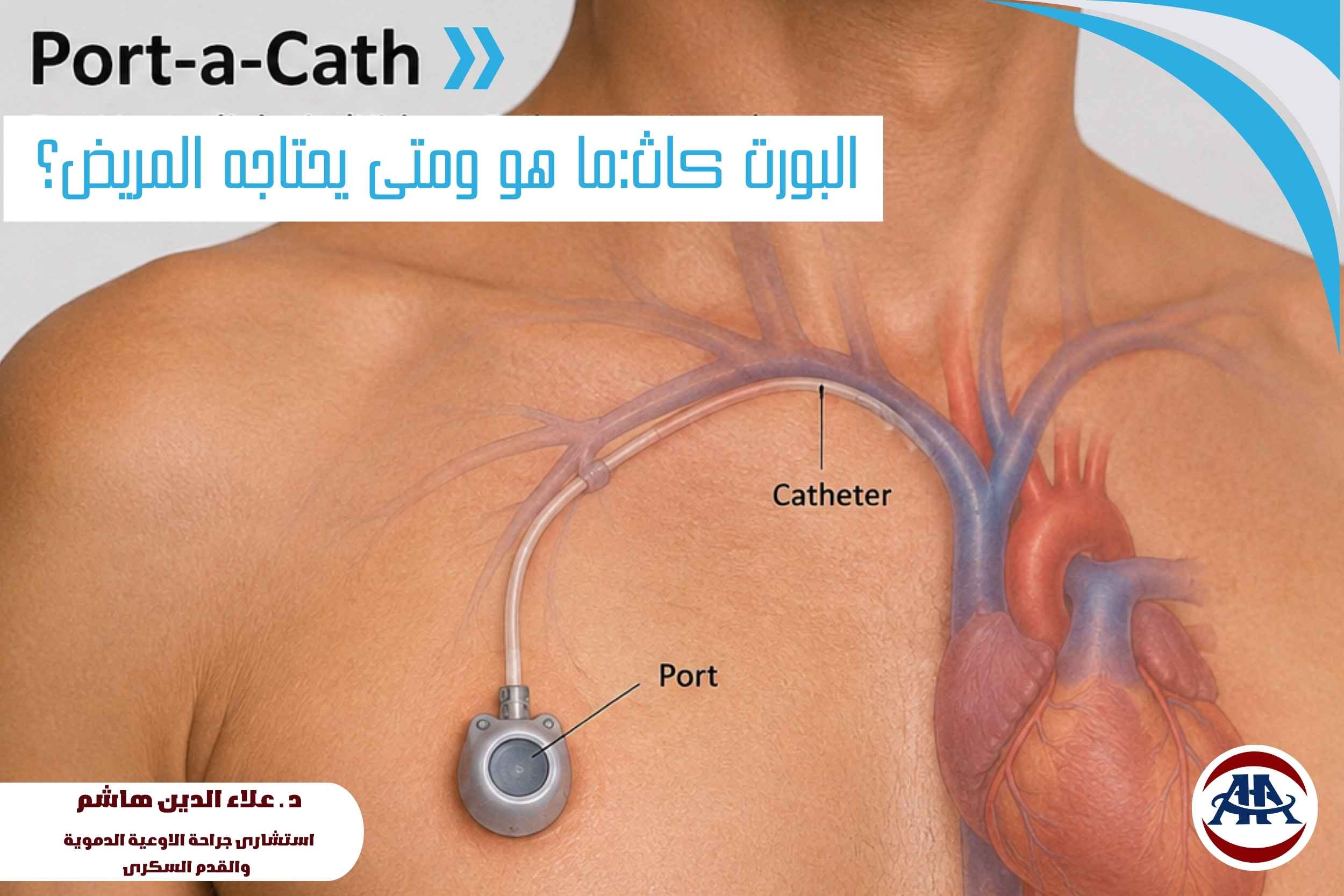 البورت-كاث-ما-هو-ومتى-يحتاجه-المريض (1) البورت-كاث-ما-هو-ومتى-يحتاجه-المريض